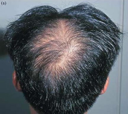 Clinical Photo - A - Before treatment